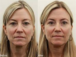Dr Darm Eyelids Before And After T C Eyelid Surgery Laser Eye Surgery Cost Eye Surgery