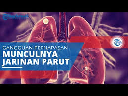 Asbestosis adalah salah satu penyakit paru yang terkait dengan paparan terhadap asbes dalam kurun waktu yang lama. Penyakit Asbestosis Gejala Penyebab Pengobatan Bisabo Channel