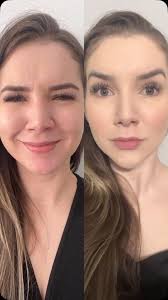 Um botox é um botox 🫶🏻🫶🏻 adeus ruguinhas 🚀