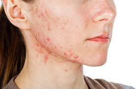 Maybe you would like to learn more about one of these? Impfung Gegen Akne In Sicht Antikorper Konnen Entzundungsreaktion In Der Haut Bekampfen Scinexx De