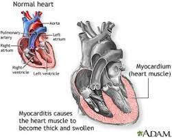 Miocardita reprezinta afectari inflamatorii sau degenerative ale muschiului inimii (miocardul) produse de cauze diverse, altele decat cardiopatia ischemica. Miocardita Cauze Semne Simptome Analize Tratament Cabinet Cardiologie Deva Dr Benteu Darius