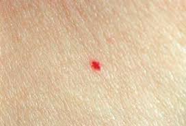 Medical involvement is really not helpful and not indicated in the. Skin Cherry Hemangiomas