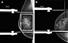 In surgery meant to treat breast cancer, lymph nodes under the arm may be removed. Intraoperative Margin Assessment In Breast Cancer Management Surgical Oncology Clinics