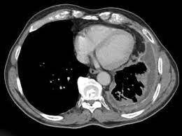 Check spelling or type a new query. Outlook On Immunotherapy Treatment For Mesothelioma Asco Connection