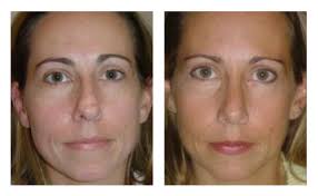 Rhinoplasty in Jacksonville. You Deserve A Perfect Nose!
