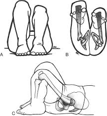 Image result for Galeazzi Sign