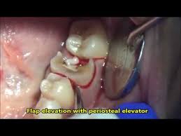 But i advice you not to try and do that instead encourage the baby to repeatedly move the teeth (if he/she is old enough for such an instruction )slowly with the aim of weakening it to a point it can move out without much pain.but still visiting the dentist. How To Pull Your Own Tooth Methods And Risks Is It Worth It