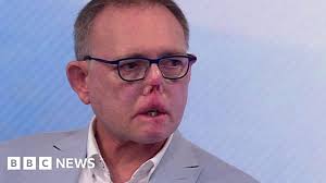 Dr Jaco Nel: I lost my legs and part of my face after sepsis from a dog  scratch