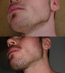The 0.5mm is the first dr size to start producing collagen, the smaller sizes are meant for better absorption of a topical like beard oils. 1st Beard Minoxidil