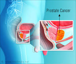 More than 200,000 men in the u.s. High Levels Of 2 Hormones In The Blood May Up Prostate Cancer Risk