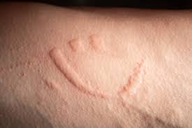 Image result for Dermatographism