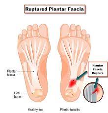 Heel pain usually builds up gradually and gets worse over time. Plantar Fasciitis Or Plantar Fascia Tear