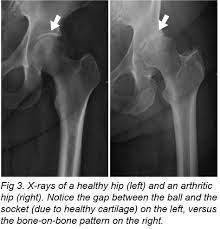 What does hip arthritis feel like. Arthritis Of The Hip Joint Mu Health Care