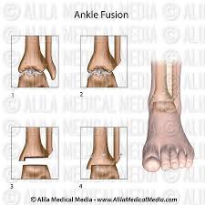 Alila Medical Media Ankle Fusion Surgery Unlabeled Diagram Medical Illustration Ankle Surgery Medical Medium Surgery