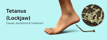 Image result for Tetanus