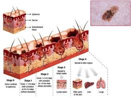 skin cancer illustration anatomy system human body