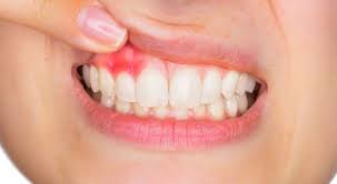أسباب انتفاخ اللثة وطرق علاجها ويب طب