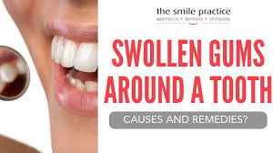 Inflammation of the gums is medically called gingivitis and can have several causes. Swollen Gums Around A Tooth Causes And Remedies The Smile Practice