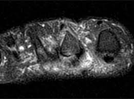 The abductor digiti minimi muscle is located on the lateral side of the foot. Lesser Metatarsophalangeal Joint Instability Radsource
