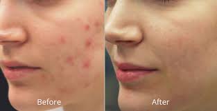 Fraxel laser treatments may also help with acne scarring for people with mild or moderate acne scarring. Fraxel Laser Skin Resurfacing Skin Care Institute Tulsa Ok