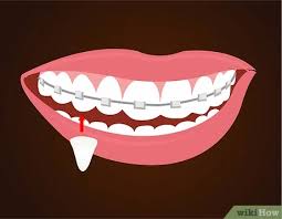 Despite what hollywood would tell you, being a vampire is not that amazing. How To Make Vampire Fangs If You Have Braces 12 Steps