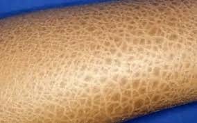Image result for Ichthyosis