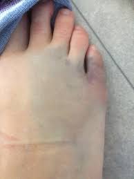 Denna del av hjärnan utsätts då för syrebrist, eftersom syret förs till hjärnan med hjälp av blodet. Blamarken 1177 Vardguiden