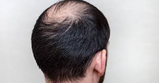 In eyebrow transplantation, the hairs above the ears or from the back of the head are transplanted to the brow. Dht And Hair Loss Hair Restoration In Toronto Hair Transplant Toronto