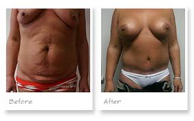 Azhar Iqbal Professional Cosmetic Surgery Before And After