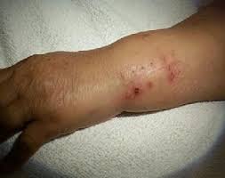 Sometimes a wound is not closing well even after the stitches are removed. Suture Or Staple Questions Aurora Co Ponderosa Family Physicians