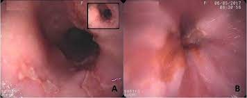 The endoscopic features between herpes simplex virus (hsv) and cytomegalovirus (cmv) esophagitis overlap significantly, and hence the differential diagnosis between hsv and cmv esophagitis is. Esophageal Cytomegalovirus And Herpes Simplex Virus Co Infection In An Immunocompromised Patient Case Report And Review Of Literature Sciencedirect
