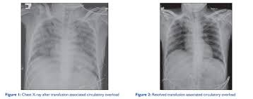 Image result for Transfusion Associated Circulatory Overload
