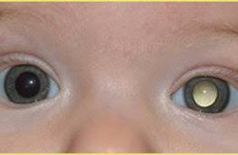 It causes abnormal development of the retina, the part of the eye that detects light. 1st Iranian Case Of Norrie Disease Reported Isna