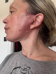 Anterior hip surgery wound care concerns after 3 weeks