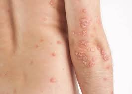 Image result for Neurodermatitis