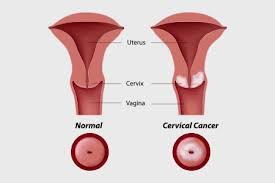 Pain in the pelvis or abdominal area. Cervical Cancer Symptoms Diagnosis And Treatment