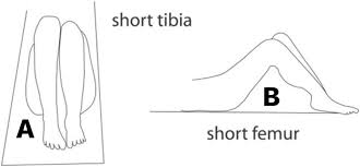 Image result for Galeazzi Sign