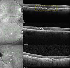 The stock analysis service is provided by marketclub, using their smart scan and trade triangle technology. Ocular Imaging For Enhancing The Understanding Assessment And Management Of Age Related Macular Degeneration Springerlink