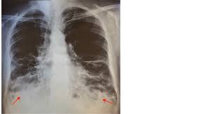Image result for Pulmonary Intoxicant