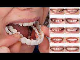 الحالات التي تحتاج ابتسامة هوليود المتحركة سناب اون سمايل snap on smile youtube live lokai bracelet lokai bracelet teeth