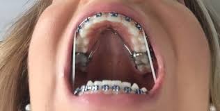 Typically, there is a small key that is turned at expanders are not something to be afraid of. Adult Braces Update 8 Month 11 Expanders Elastics