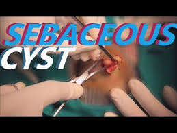 Kafa Derisinden Sebase Kist Yag Bezesi Cikarilmasi Sebaceous Cyst Youtube