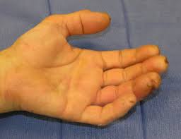 Image result for Hand Infection