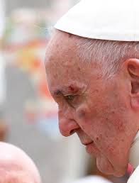 Pope Francis left with a black eye and ...