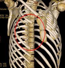 What organ is located is middle of chest under end of rib cage? Chest Wall Lumps Rib Injury Clinic