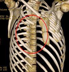 It's no surprise that a lung cancer can cause pain under the right rib, considering the location of the lungs (inside the ribcage). Chest Wall Lumps Rib Injury Clinic