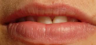 Lippenherpes Herpes Labialis Ursachen Beschwerden Diagnose Behandlung Prognose Vorbeugung Gesundmed Medizin Und Gesundheit Im Web