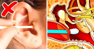 As new wax is produced, the old wax is pushed further outwards. 15 Effective Home Remedies To Remove Ear Wax Safely