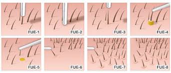 Fue Hair Transplant Faq Http Ilht Pakistan Blogspot Com 2014 12 Fue Hair Transplant Faq Html Skin And Hair Clinic Skin Clinic Fue Hair Transplant