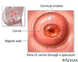 Image result for Friable Cervix